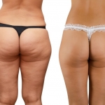 Cellulite-before-and-after-1000